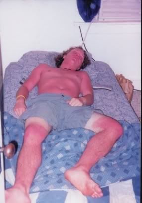 SUN POISONING