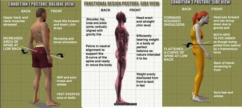 Increased Lumbar Lordosis